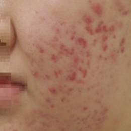 レーザーフェイシャル