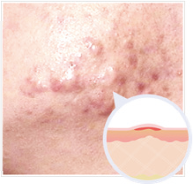 アクネケロイド