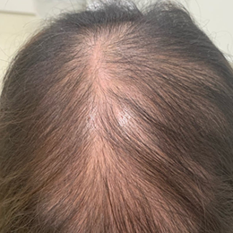 女性のうす毛・抜け毛