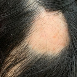 うす毛・抜け毛