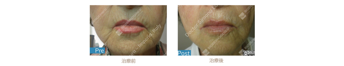 ビーワンリフト