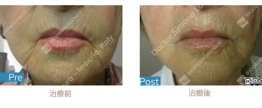 ビーワンリフト