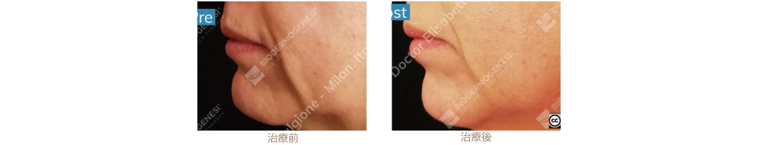 ビーワンリフト