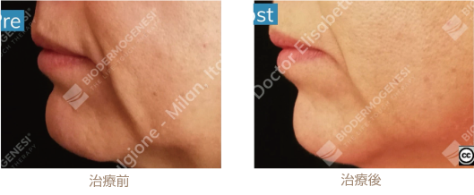 ビーワンリフト