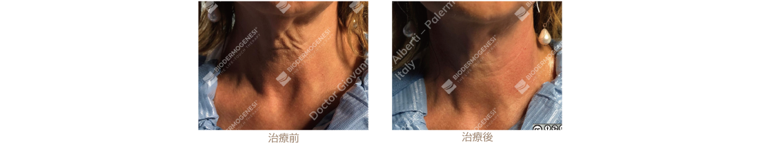 ビーワンリフト