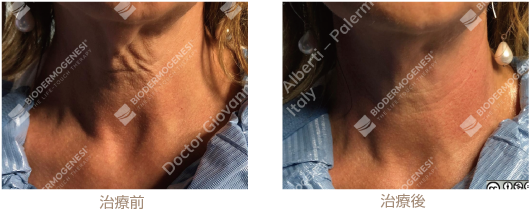 ビーワンリフト