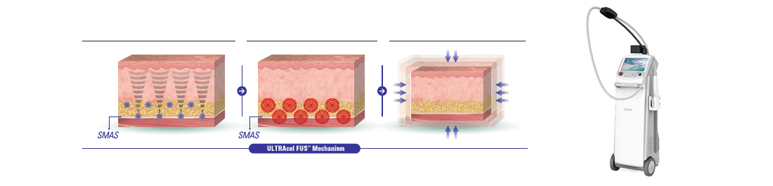 ウルトラセルQプラス