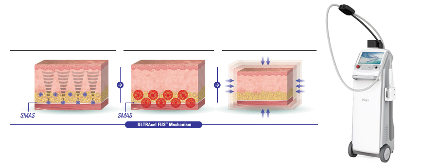 ウルトラセルQプラス