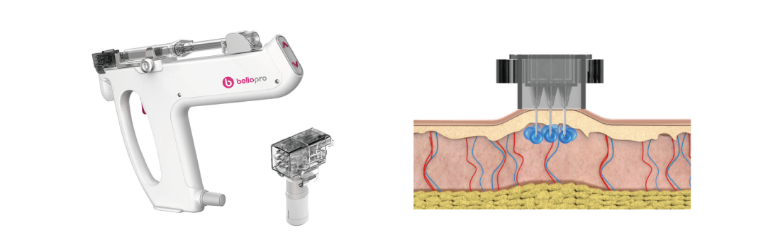 レーザーシャワー