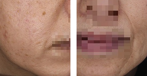 深いしわ・たるみ