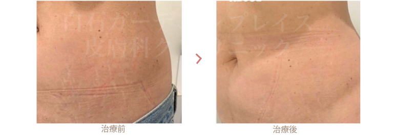 瘢痕の治療
