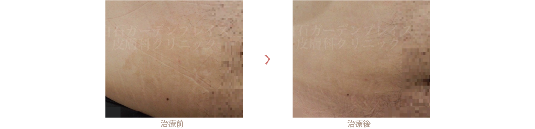 瘢痕の治療