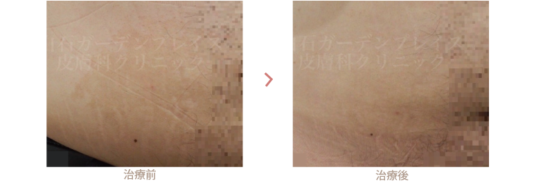 瘢痕の治療