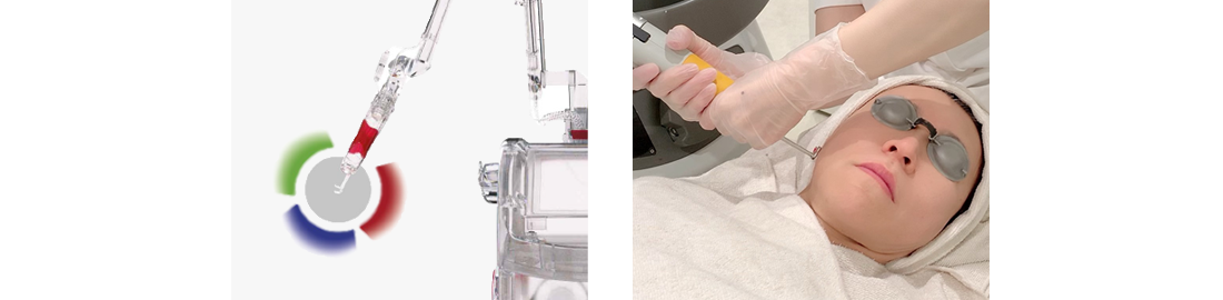 レーザートーニング、レーザーフェイシャル