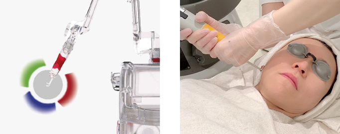 レーザートーニング、レーザーフェイシャル