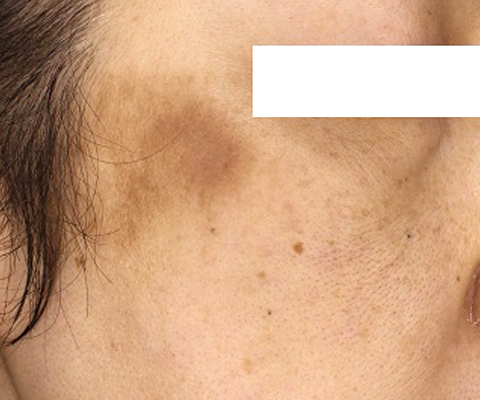 炎症後色素沈着