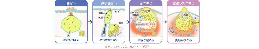 ニキビができる流れ