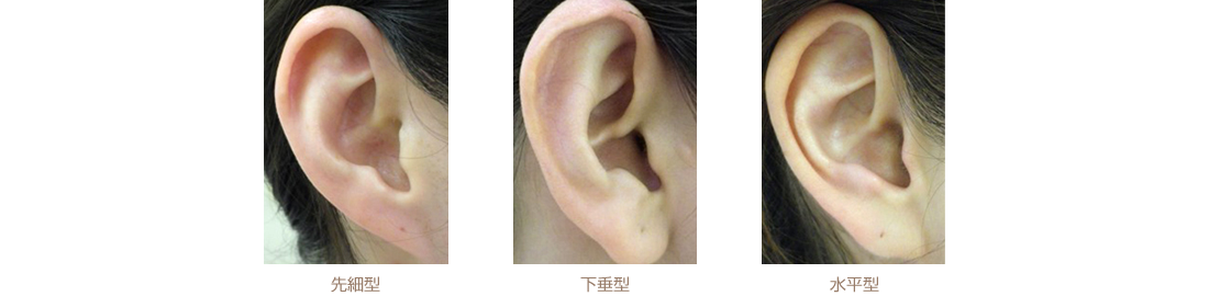 先細り型、水平型、下垂型