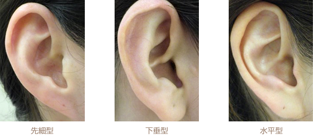 先細り型、水平型、下垂型