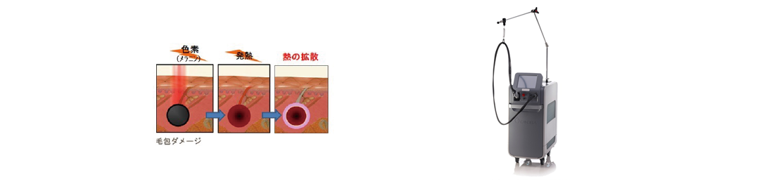 レーザー脱毛について