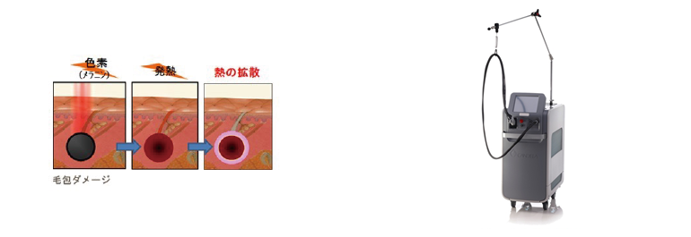 レーザー脱毛について