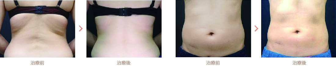 治療間隔と回数