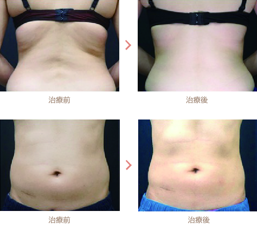 治療間隔と回数