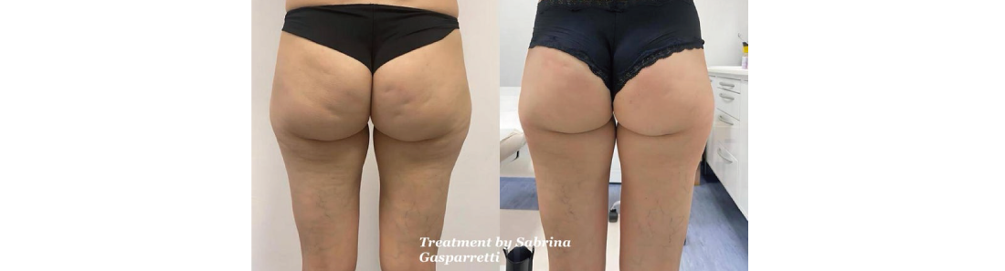 治療間隔と回数