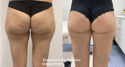 治療間隔と回数