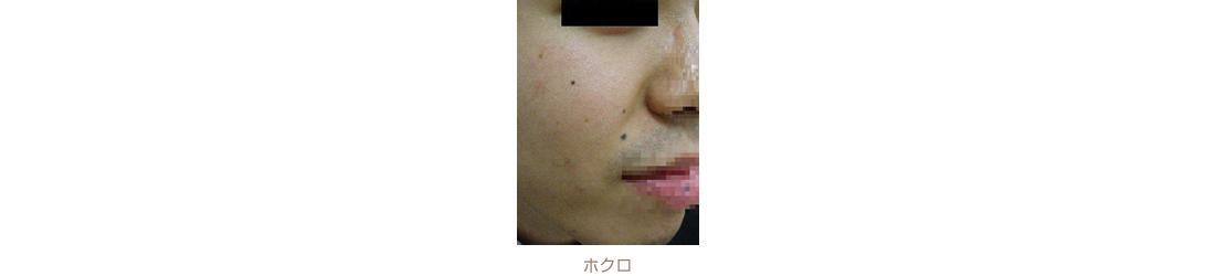 ホクロ