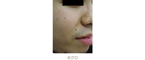 ホクロ