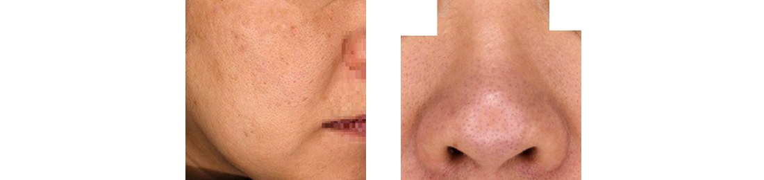 毛穴が目立つ原因