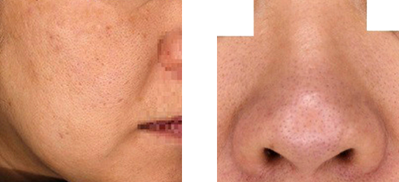 毛穴が目立つ原因