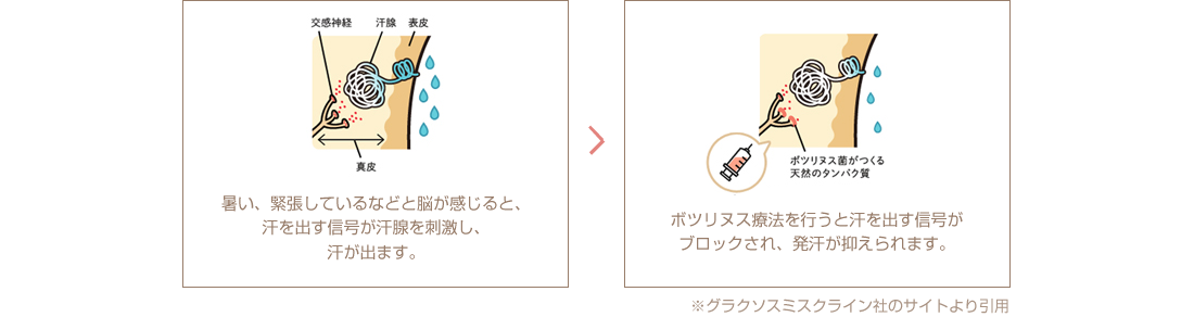 ワキボトックス