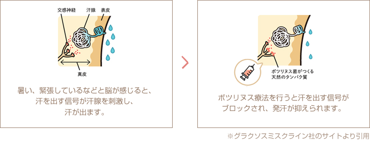 ワキボトックス