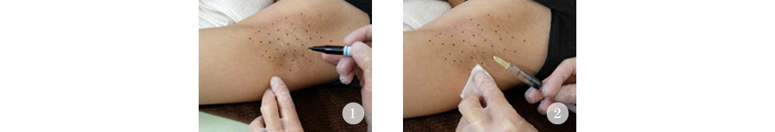 ワキボトックス　治療の流れ 