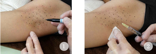 ワキボトックス　治療の流れ